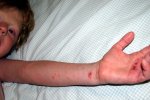 Zmiany skórne przy AZS swędzą i są powodem frustracji małych pacjentów (fot. foter.com)