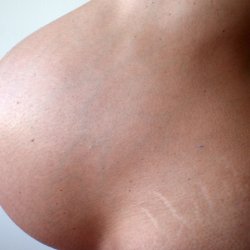 Białe bruzdy na ciele zwane rozstępami pojawiają się najczęściej w okresie dojrzewania i w ciąży (fot. foter. com)