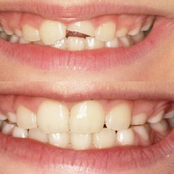 Ułamany ząb można dokleić. Wystarczy tylko zastosować się do wskazówek zawartych w poniższym tekście (fot. materiał prasowy Śmigiel Dental)