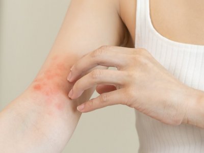 Atopowe zapalenie skóry jest problemem zdrowotnym, wymagającym kompleksowego podejścia