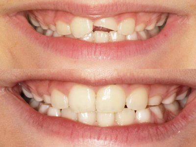 Ułamany ząb można dokleić. Wystarczy tylko zastosować się do wskazówek zawartych w poniższym tekście (fot. materiał prasowy Śmigiel Dental)